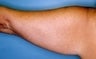 42 year old female patient