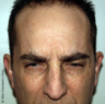 Botox Treatment for Forehead Wrinkles