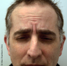 Botox Treatment for Forehead Wrinkles