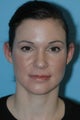 Young female underwent a 12 minute closed tip Rhinoplasty