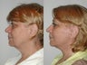 69 Year Old Female Treated for Sagging Jowls