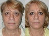 69 Year Old Female Treated for Sagging Jowls
