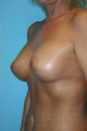 Breast Lift