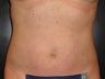 SmartLipo