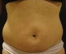 SmartLipo