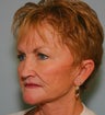 59 y/o with Redo Facelift, Browlift & Lower Blepharoplasty