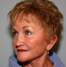 59 y/o with Redo Facelift, Browlift & Lower Blepharoplasty