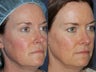 Before & After IPL