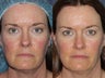 Before & After IPL