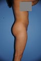 Butt Implants