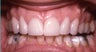 Smile Makeovers