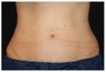 CoolSculpting