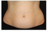 CoolSculpting