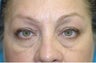 Upper and Lower Blepharoplasty (eyelid surgery)