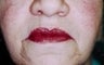 62 year old female patient