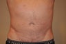 Male Liposuction of Abdominals & Flanks