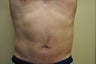 Male Liposuction of Abdominals & Flanks
