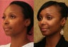 African American Rhinoplasty