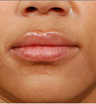 Juvederm - before and after