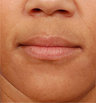 Juvederm - before and after