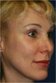 47 year old female treated for droopy eye brows and eye lids