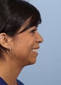 Female Chin Implant