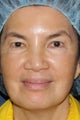 63 year old Asian female with brown spots and sun damage with Fraxel Dual and Alex laser