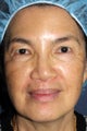 63 year old Asian female with brown spots and sun damage with Fraxel Dual and Alex laser