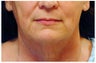 Facial Rejuvenation