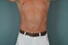 Liposuction