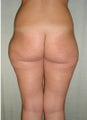 Liposuction