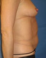 Liposuction