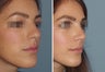 Female Primary Rhinoplasty