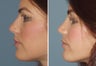 Female Primary Rhinoplasty