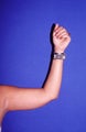 40 Year Old Female Treated with Smart Lipo to Upper Arms