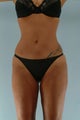 liposuction