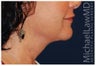 Lower Facial Rejuvenation