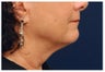 Lower Facial Rejuvenation