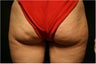 SmartLipo MPX