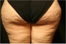 SmartLipo MPX