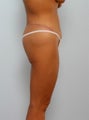 Body Lift
