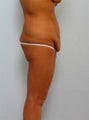 Body Lift
