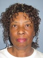 LiteLift™ on 65-year-old Woman