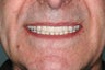 Male Received Dental Implants