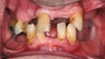 Male Received Dental Implants