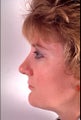 Rhinoplasty for a projecting nose
