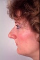 Rhinoplasty for a projecting nose