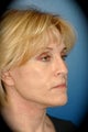 Laser Skin Resurfacing