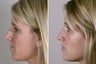 Female Rhinoplasty