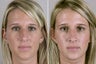 Female Rhinoplasty